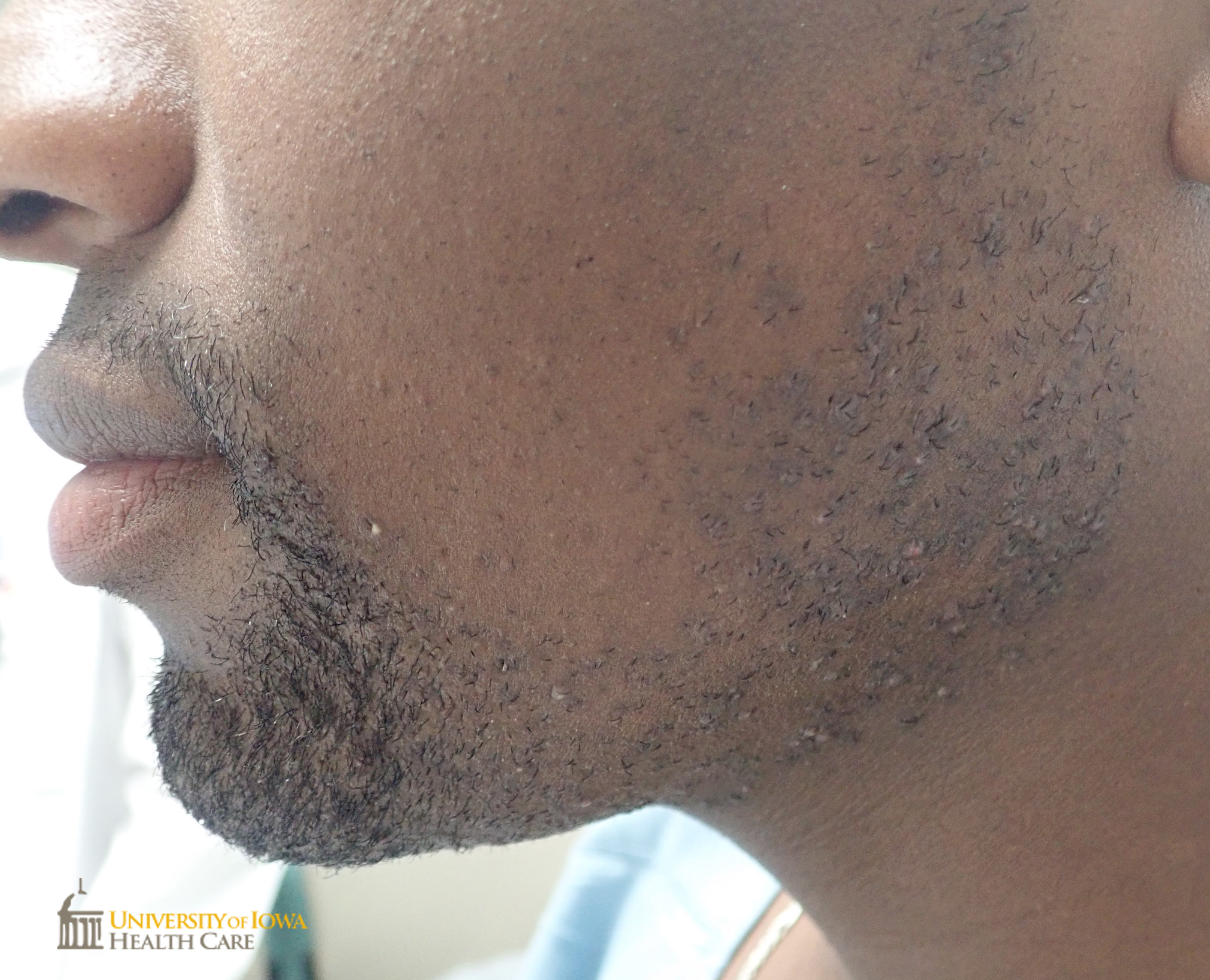 Perifollicular hyperpigmented papules confined to the beard area. (click images for higher resolution).